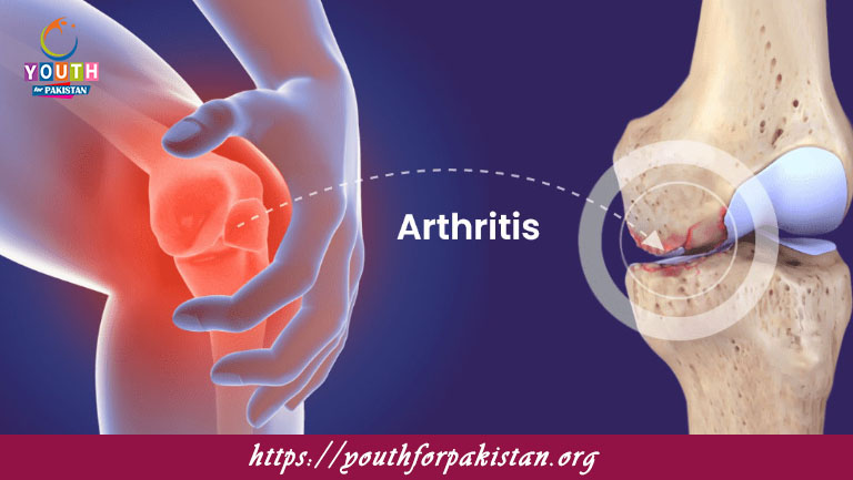 Arthritis MDCAT Quiz